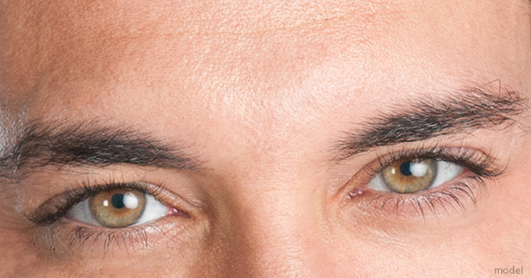 Eyelid Lift (Blepharoplasty)
