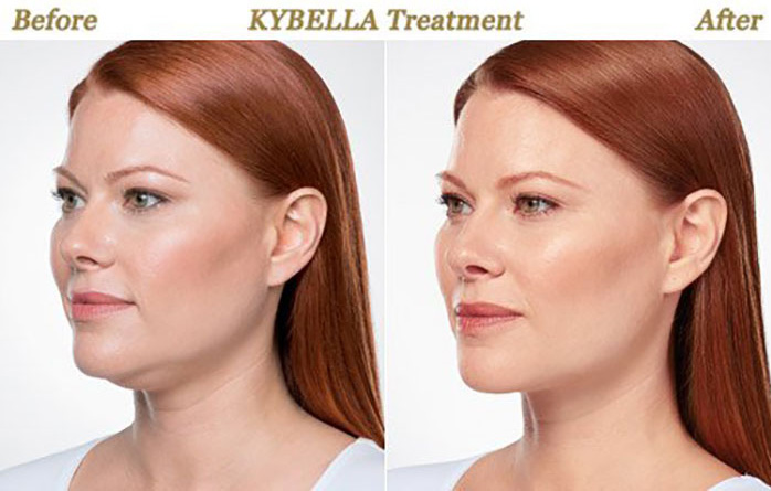 Kybella® Before and After