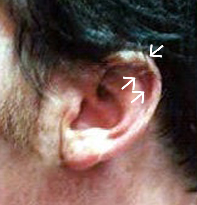 Ear Reshaping After
